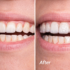 Dr Gautam Dental Rajajipuram Invisible Aligner